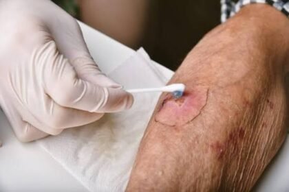 How To Choose the Right Wound Care Specialist for Your Needs