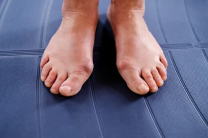 What To Expect Before and After Bunion Surgery