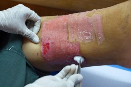 Home Care Tips for Managing Wounds