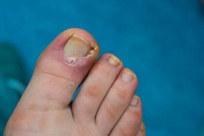 How To Prevent and Treat Ingrown Toenails