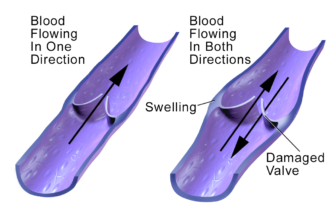 How Varithena Addresses Varicose Veins