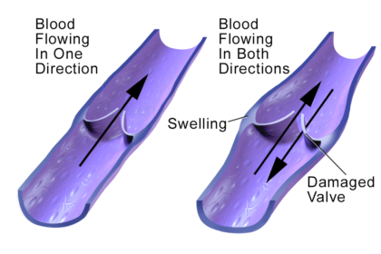 How Varithena Addresses Varicose Veins