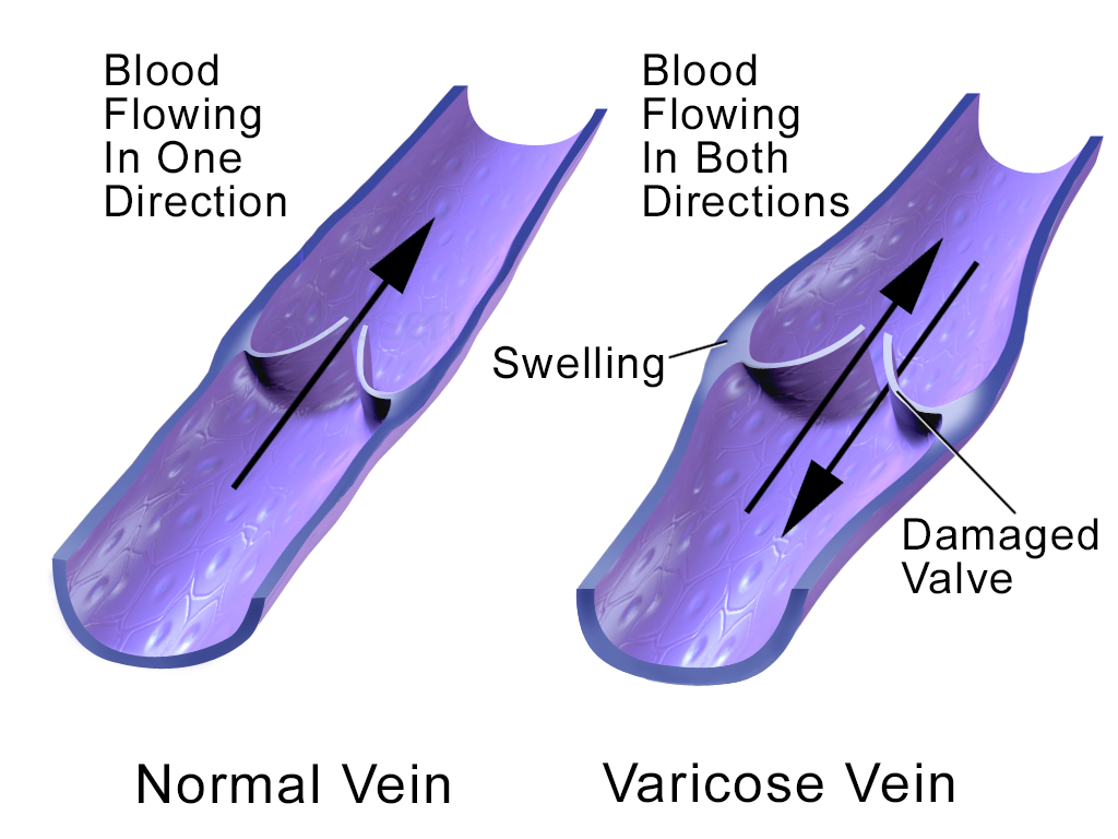 How Varithena Addresses Varicose Veins