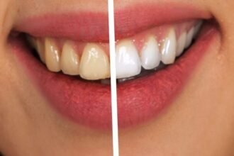 Ways to Keep Your Teeth White After Whitening Treatments