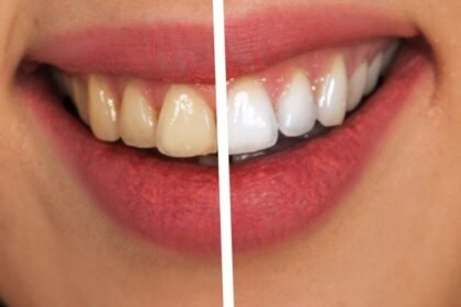 Ways to Keep Your Teeth White After Whitening Treatments