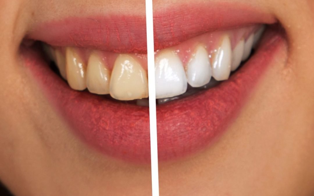 Ways to Keep Your Teeth White After Whitening Treatments