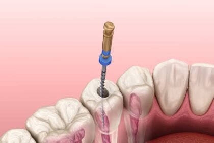 What Patients Should Know About Endodontic Implants