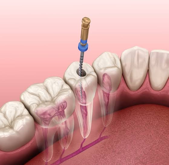 What Patients Should Know About Endodontic Implants