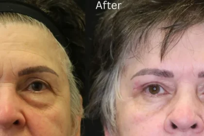What Is Mohs Skin Cancer Surgery?
