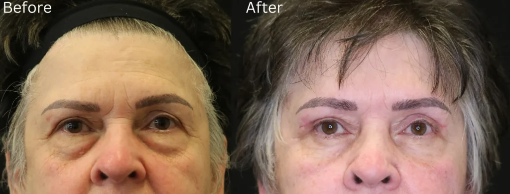 What Is Mohs Skin Cancer Surgery?