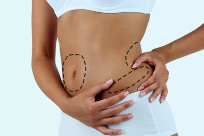 What to Expect During Your Liposuction Consultation